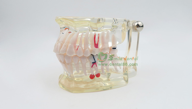 TM-C2 Pathology Model with a tooth missing